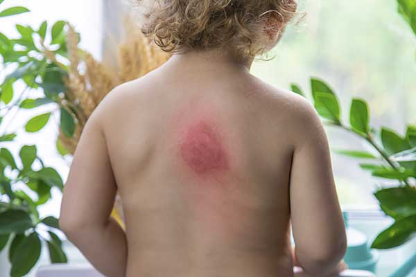 dermatitis-thickened-skin-in-child